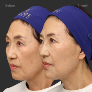 オーダーメイドヒアルリフト（ジュビダーム10㏄）