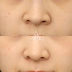 耳介軟骨移植＋鼻尖形成＋鼻翼縮小(内側)＋鼻翼挙上