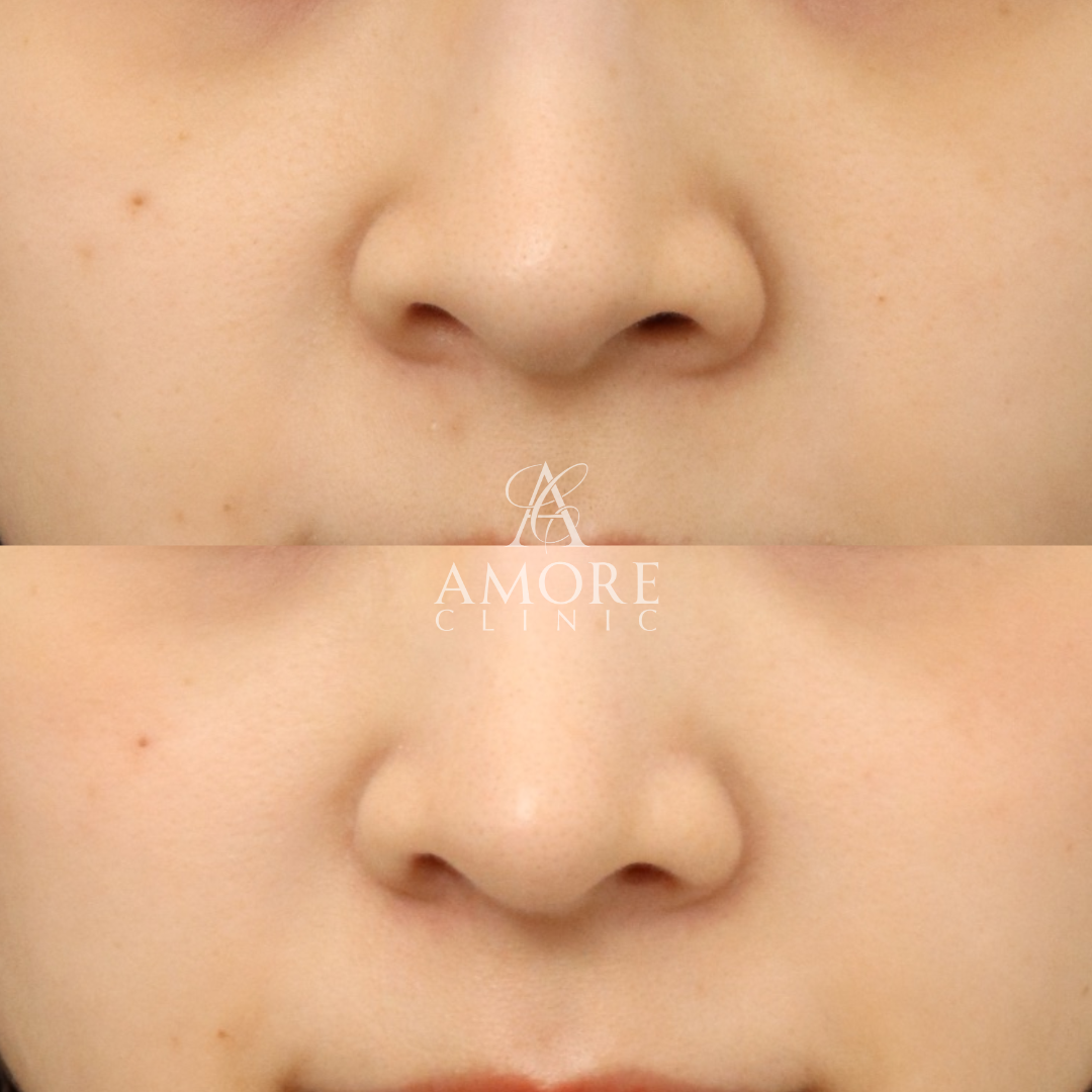 耳介軟骨移植＋鼻尖形成＋鼻翼縮小(内側)＋鼻翼挙上