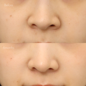 耳介軟骨移植＋鼻尖形成＋鼻翼縮小(内側)＋鼻翼挙上