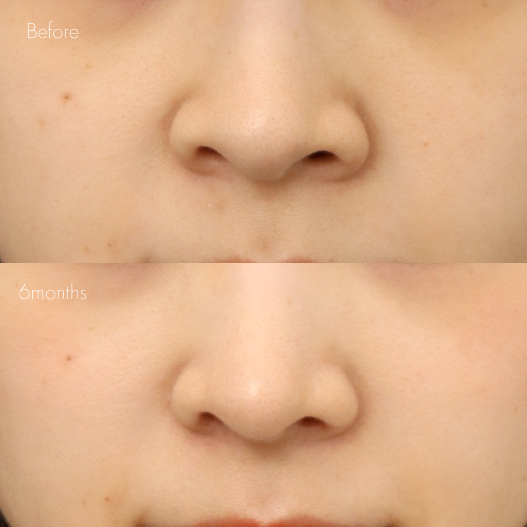 耳介軟骨移植＋鼻尖形成＋鼻翼縮小(内側)＋鼻翼挙上