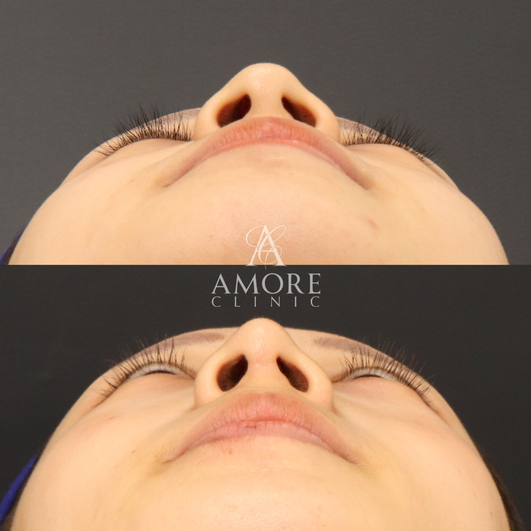 耳介軟骨移植＋鼻尖形成＋鼻翼縮小(内側)＋鼻翼挙上