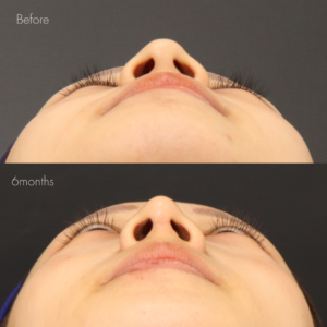 耳介軟骨移植＋鼻尖形成＋鼻翼縮小(内側)＋鼻翼挙上