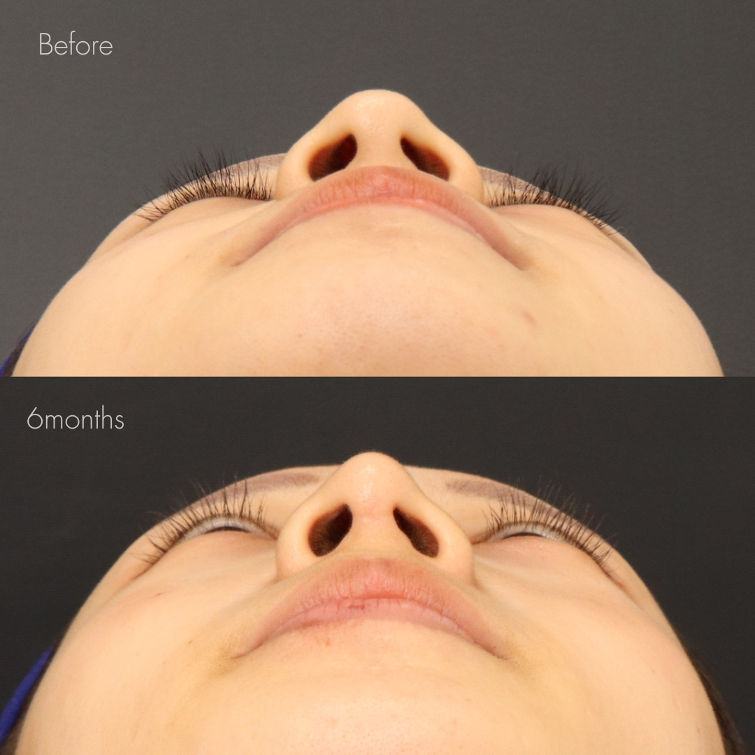 耳介軟骨移植＋鼻尖形成＋鼻翼縮小(内側)＋鼻翼挙上