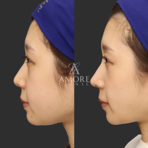 耳介軟骨移植＋鼻尖形成＋鼻翼縮小(内側)＋鼻翼挙上