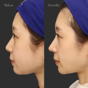 耳介軟骨移植＋鼻尖形成＋鼻翼縮小(内側)＋鼻翼挙上