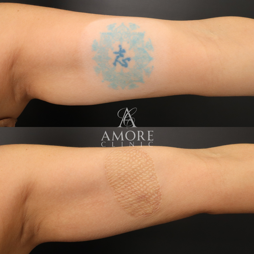 タトゥー除去（植皮法）