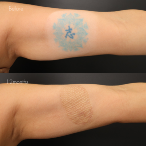 タトゥー除去（植皮法）