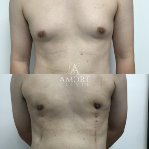 女性化乳房（乳腺・乳房脂肪除去）