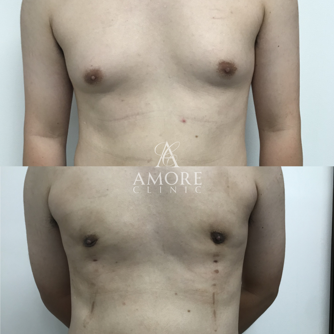 女性化乳房（乳腺・乳房脂肪除去）