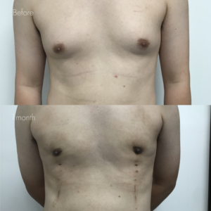 女性化乳房（乳腺・乳房脂肪除去）