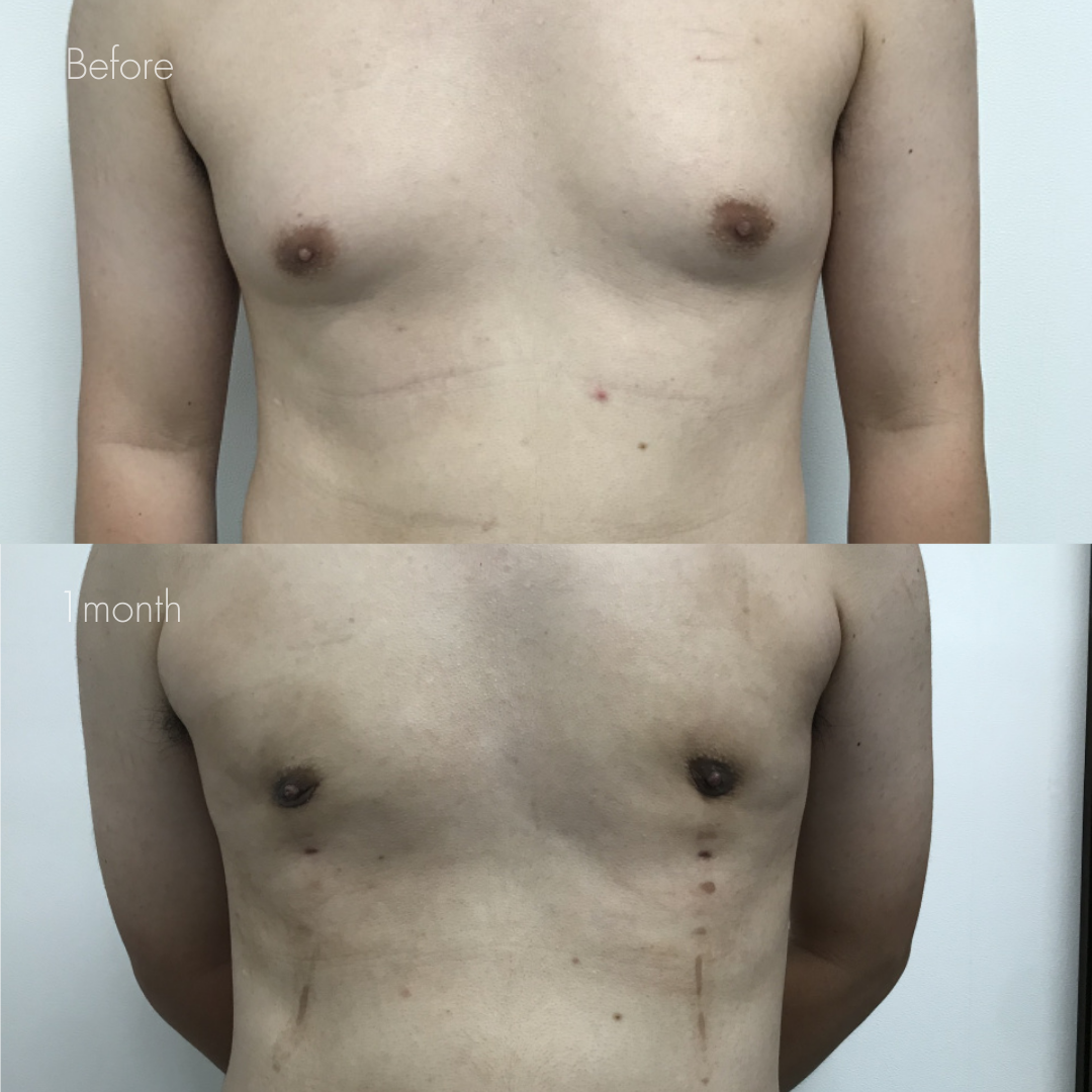 女性化乳房（乳腺・乳房脂肪除去）