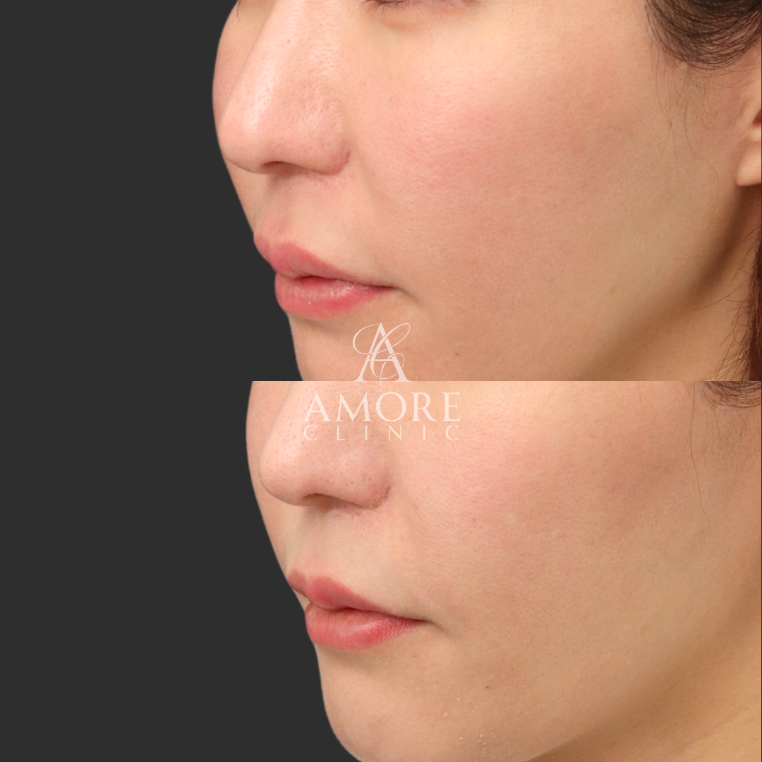 貴族リフト（6本）