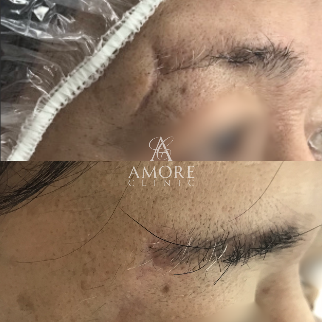 傷跡修正（切開法）