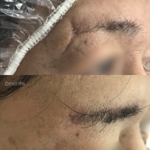 傷跡修正（切開法）