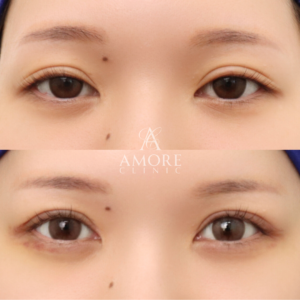 二重全切開（他院修正）＋たるみ除去＋脂肪除去