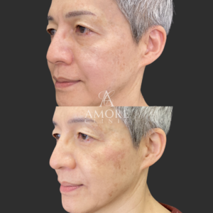 鼻フルヒアルロン酸