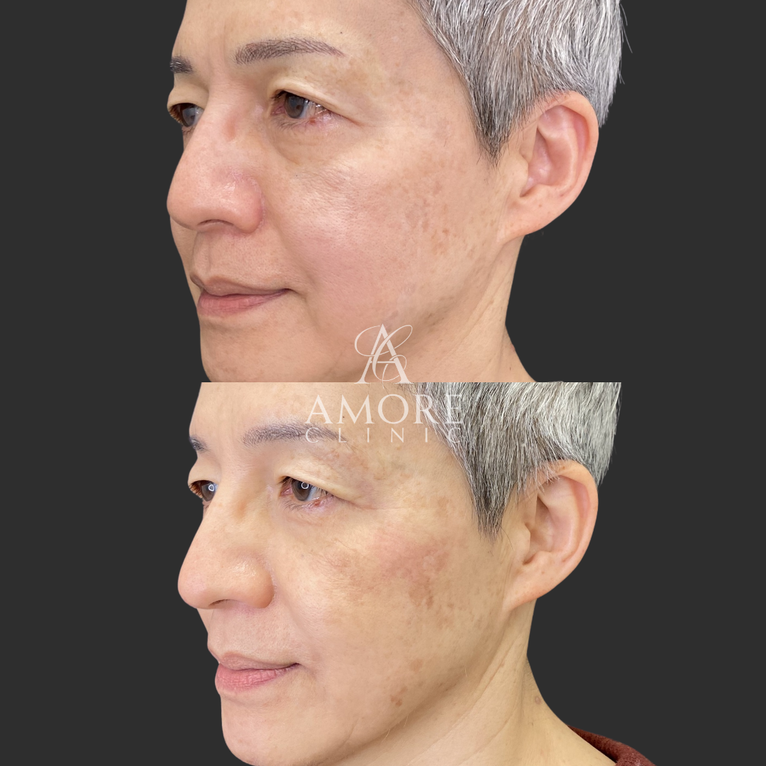 鼻フルヒアルロン酸