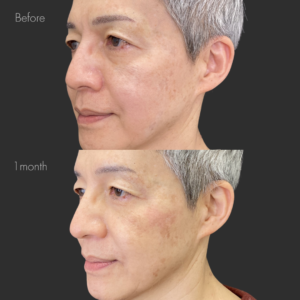 鼻フルヒアルロン酸