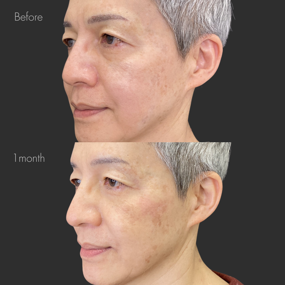 鼻フルヒアルロン酸