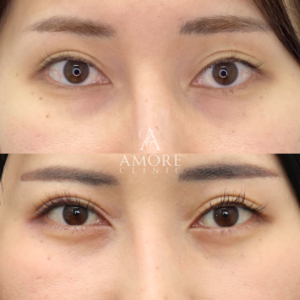 下眼瞼脱脂 （結膜側）