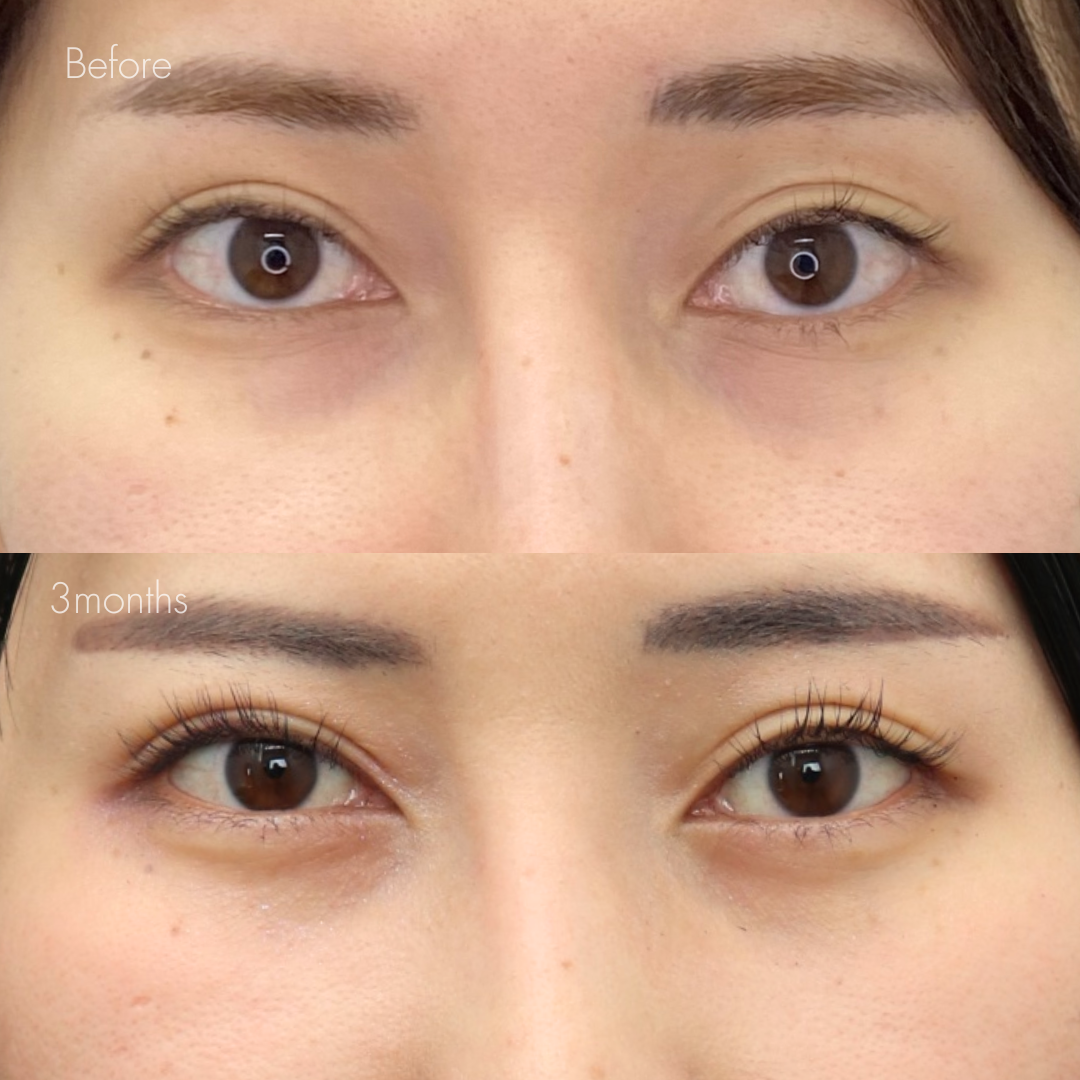 下眼瞼脱脂 （結膜側）