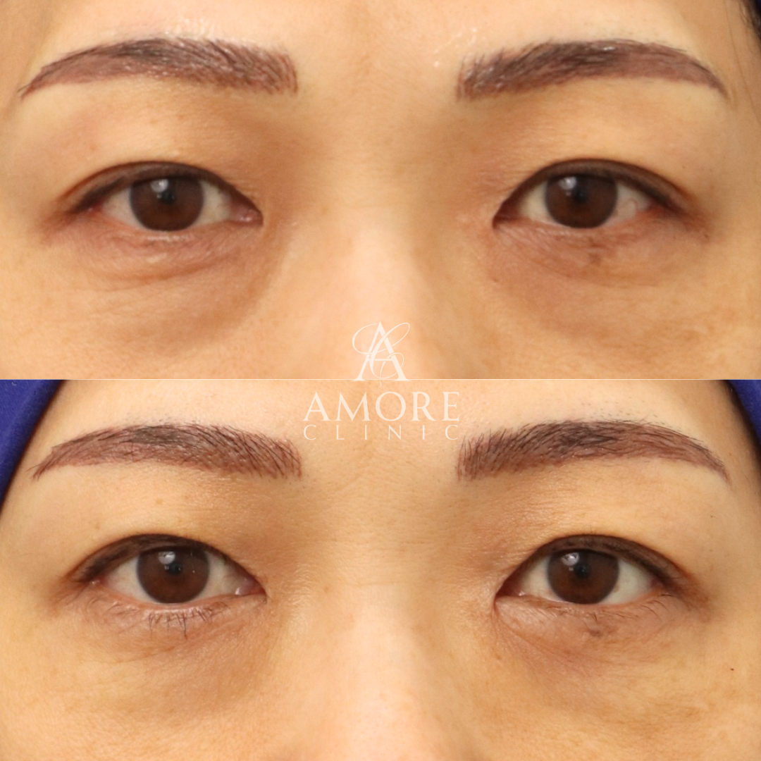 下眼瞼脱脂 （結膜側）