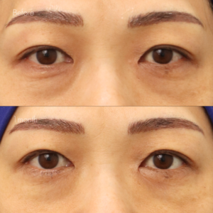 下眼瞼脱脂 （結膜側）