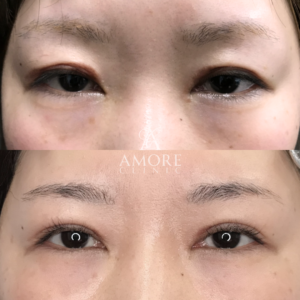 二重全切開（他院修正）＋たるみ取り＋目頭切開＋ケロイド除去