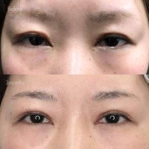 二重全切開（他院修正）＋たるみ取り＋目頭切開＋ケロイド除去