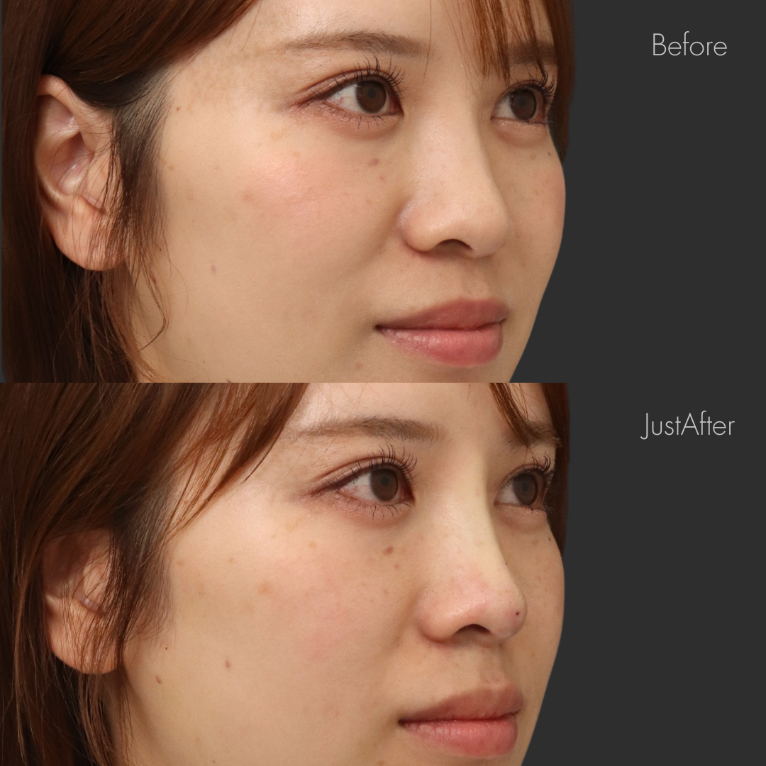 ノーズスレッド（Y-ko6本）