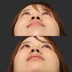 ノーズスレッド（Y-ko6本）