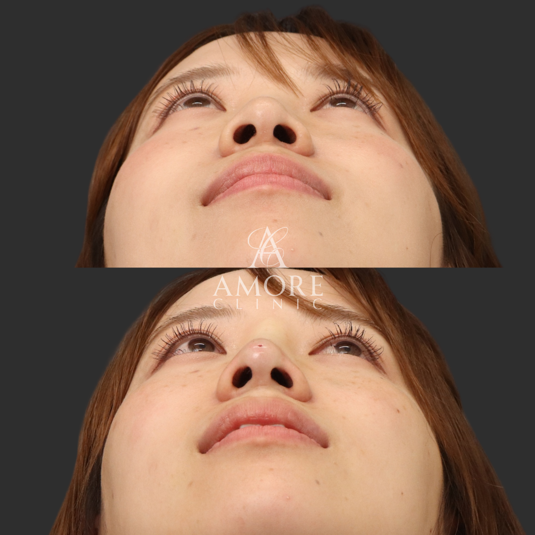 ノーズスレッド（Y-ko6本）