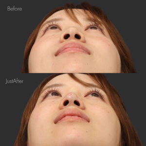 ノーズスレッド（Y-ko6本）