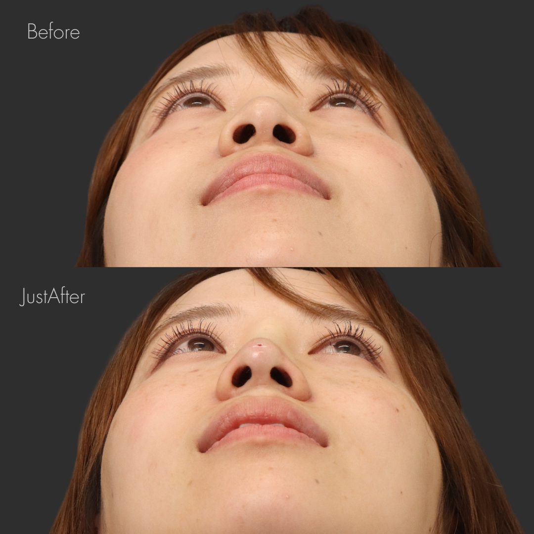 ノーズスレッド（Y-ko6本）