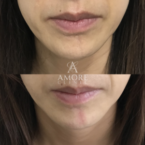 傷跡修正（切開法）