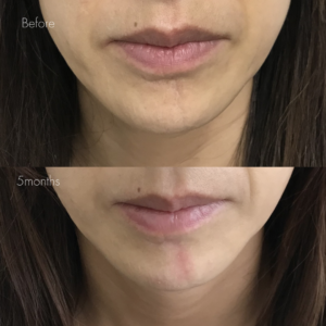 傷跡修正（切開法）