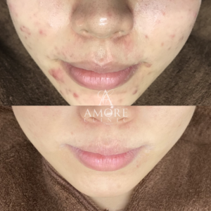 重症ニキビ改善コース＋イソトレチノイン内服