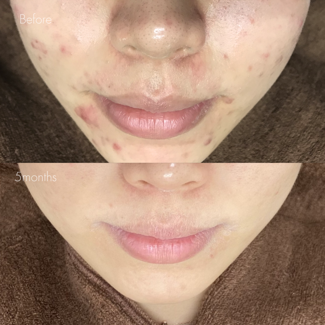 重症ニキビ改善コース＋イソトレチノイン内服