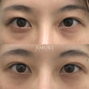 眼瞼下垂＋たるみ取り＋脂肪取り＋目尻切開＋グラマラスライン形成＋埋没糸抜去