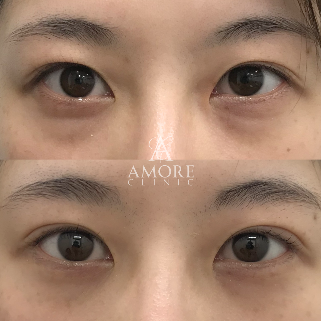 眼瞼下垂＋たるみ取り＋脂肪取り＋目尻切開＋グラマラスライン形成＋埋没糸抜去