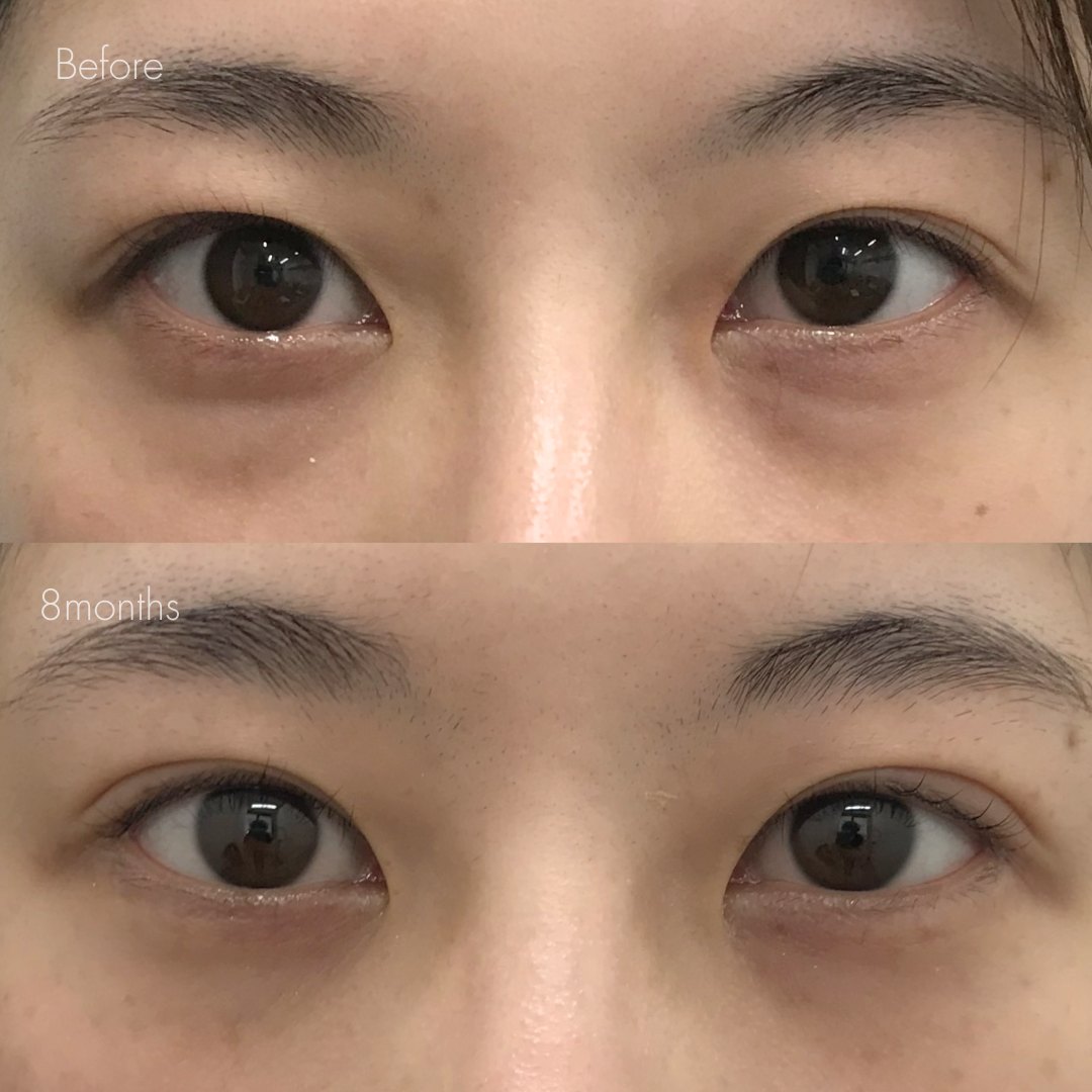 眼瞼下垂＋たるみ取り＋脂肪取り＋目尻切開＋グラマラスライン形成＋埋没糸抜去