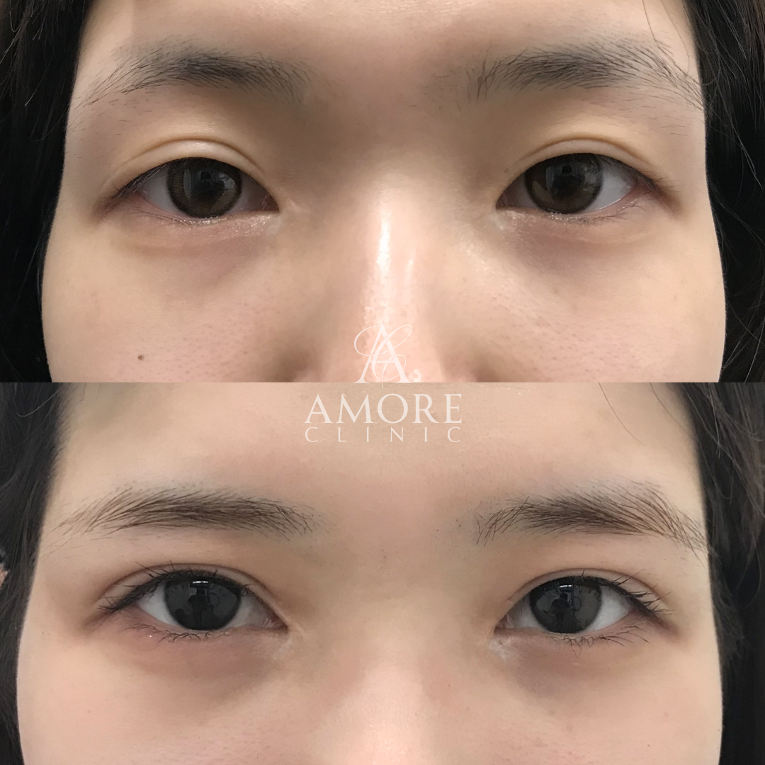 二重全切開（他院修正）＋たるみ除去、目頭切開