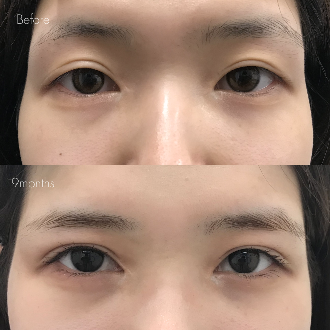 二重全切開（他院修正）＋たるみ除去、目頭切開