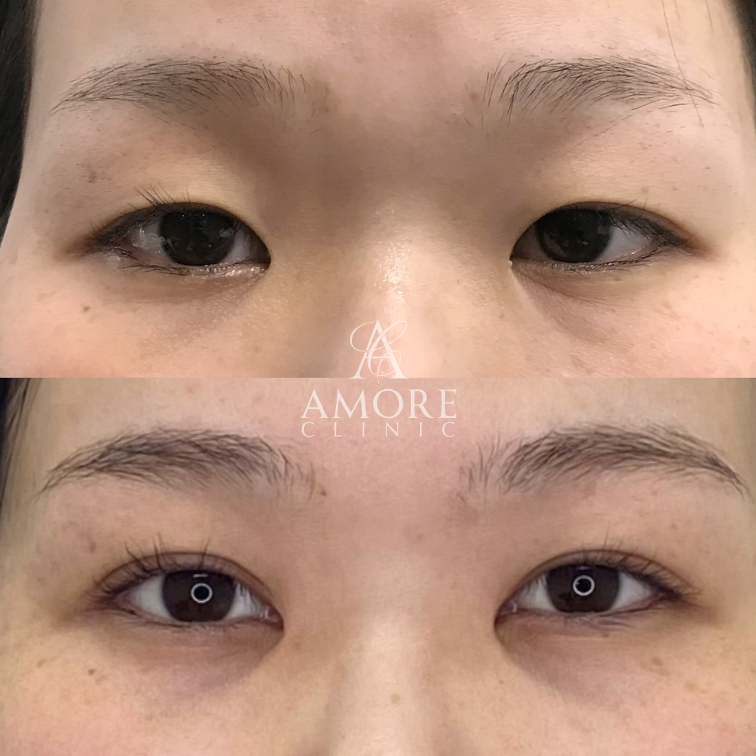 パーフェクト二重術（二重全切開＋たるみ除去＋脂肪除去）＋目頭切開