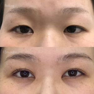 パーフェクト二重術（二重全切開＋たるみ除去＋脂肪除去）＋目頭切開