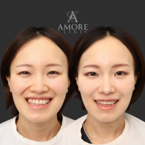 鼻翼縮小（内側）