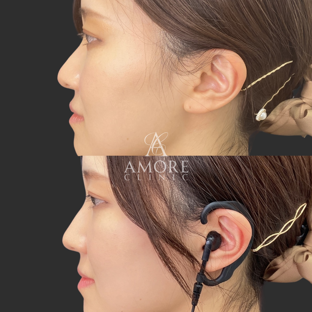 鼻フルヒアルロン酸