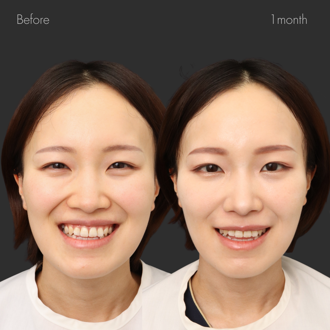 鼻翼縮小（内側）