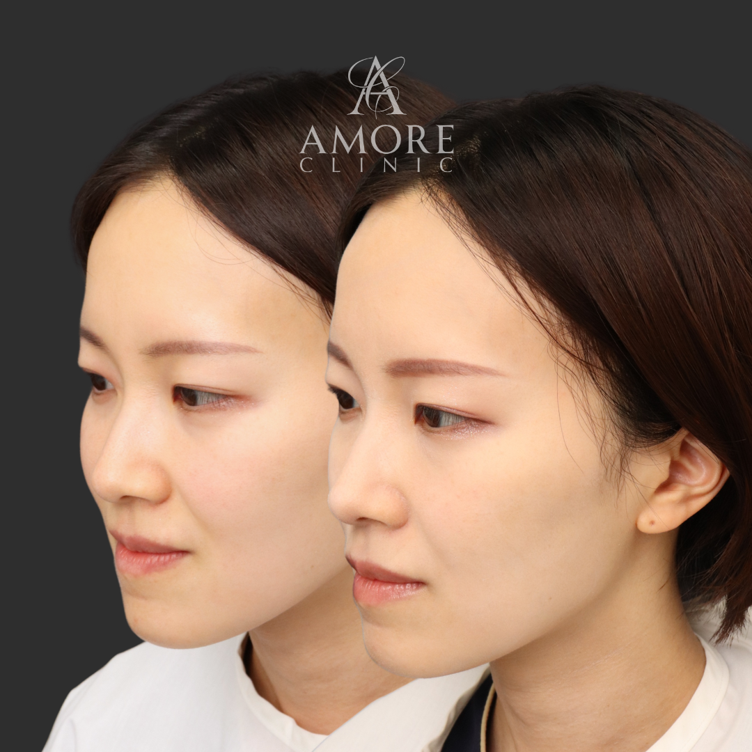 鼻翼縮小（内側）